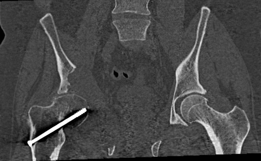 Figure 2 for case Primary angiosarcoma of bone